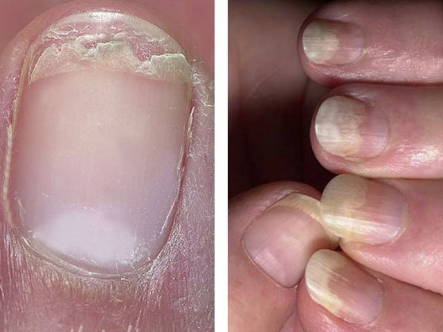 Грибок ногтей на руках лечение в домашних условиях
