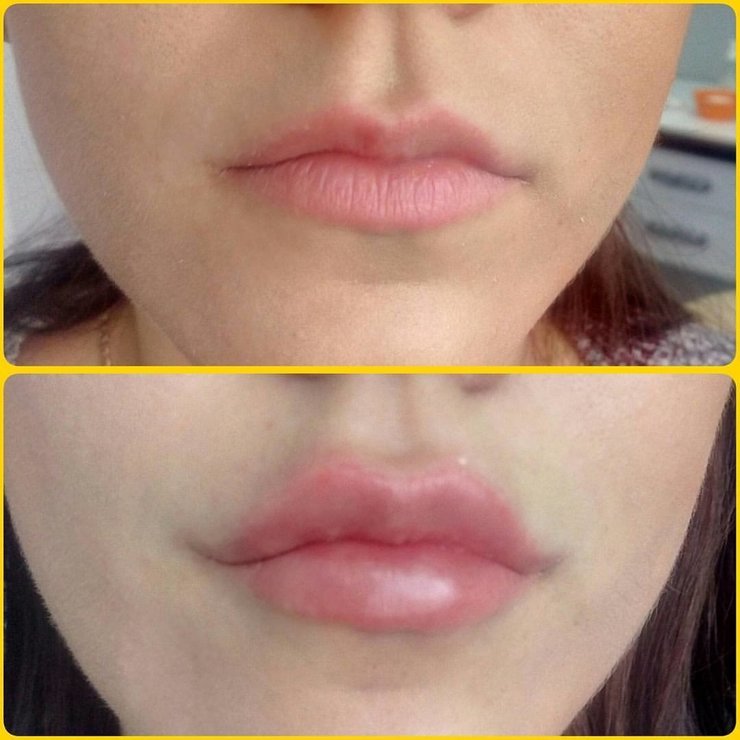 Нанонапыление губ фото до и после
