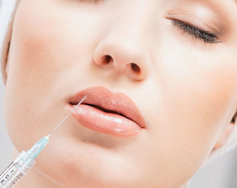 Вкалывание гиалуроновой кислоты в губы 