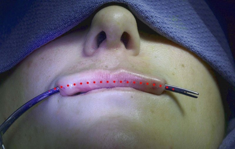 Установка имплантов в губы