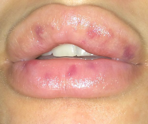 Синяки после увеличения губ