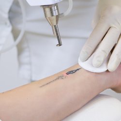 Лазерное удаление татуировки