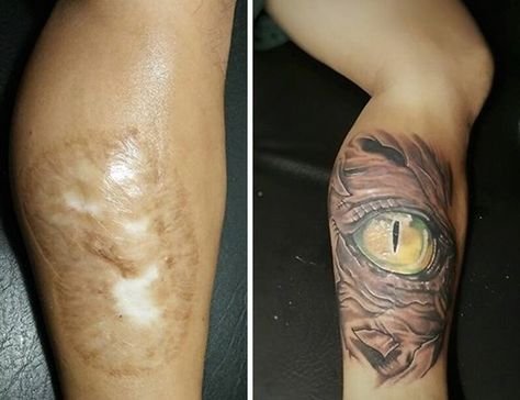 Перекрытие шрама татуировкой