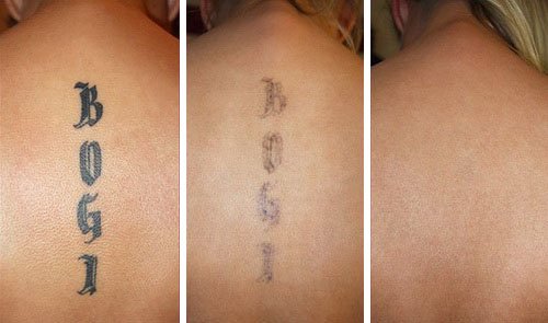Удаление татуировки на спине