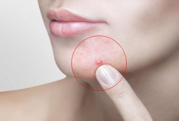 Мазь от подкожных прыщей на лице: 7 эффективных средств Прыщ на лице