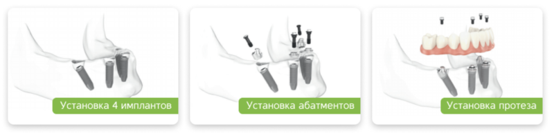 Что нужно знать о протоколе All‑on‑4 перед установкой имплантов